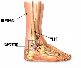 足踝受傷部位介紹