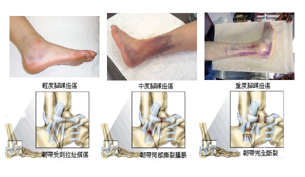 各種足踝扭傷示意圖